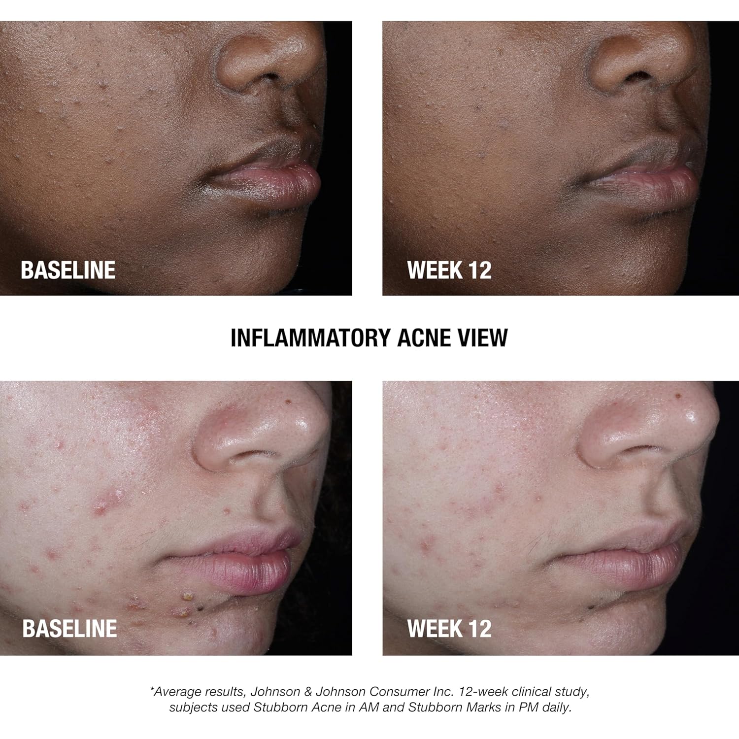 Neutrogena Stubborn Acne AM Treatment 2.5% Benzoyl Peroxide 2oz